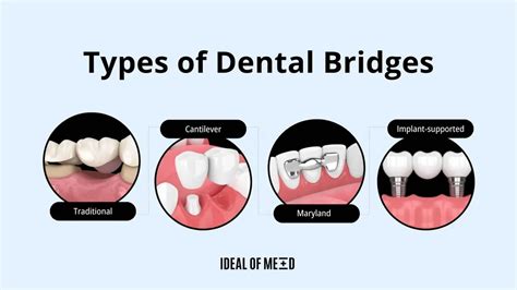 Dental Bridge: Types, Advantages, Cost, and More.